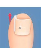 50db Benőtt Köröm Korrekciós Csíkok - Légáteresztő és Rugalmas Pedikűr Eszköz a Fájdalomcsillapításért és Köröm Egészségéért