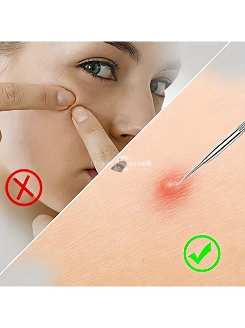 Mitesszer eltávolító készlet - Professzionális bőrápoló eszköz készlet a hatékony pórustisztításhoz