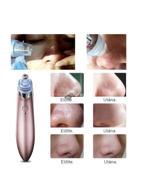 Vákuumos Mitesszer Eltávolító