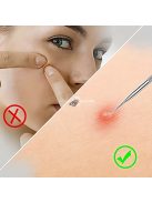 Mitesszer eltávolító készlet