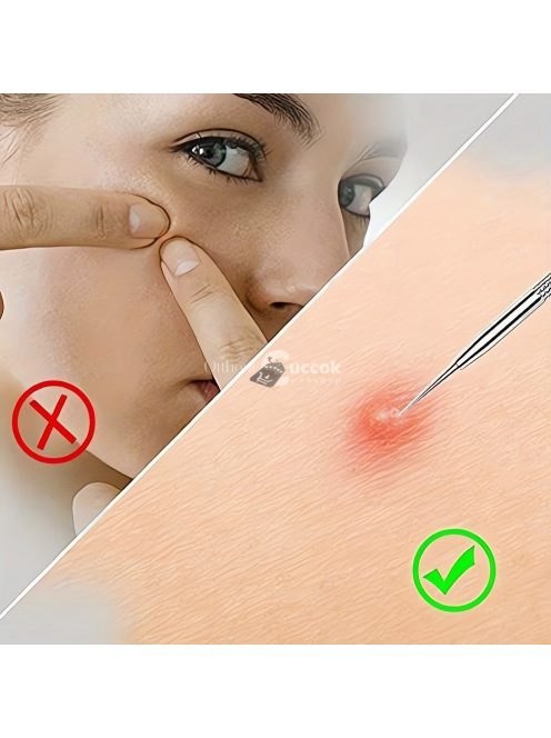 Mitesszer eltávolító készlet