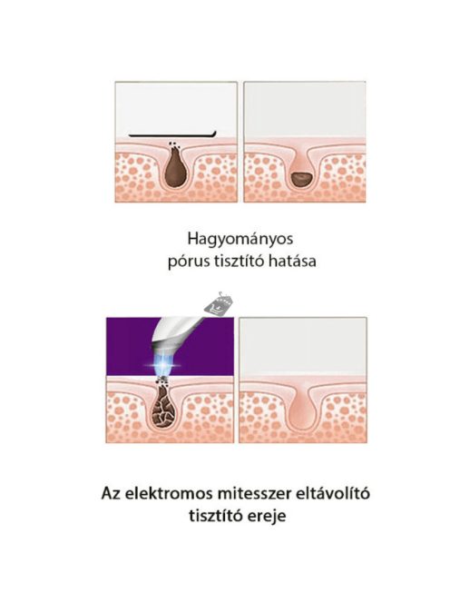 Mitesszer eltávolító, vákuumos pórustisztító
