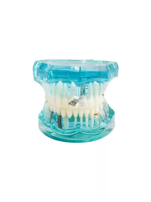 Fogmodell állkapocs fogak fog implantátumok - Fogorvosi modell állkapocs fogakkal és implantátumokkal