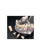 Fogmodell állkapocs fogak fog implantátumok - Fogorvosi modell állkapocs fogakkal és implantátumokkal