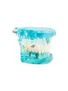 Fogmodell állkapocs fogak fog implantátumok - Fogorvosi modell állkapocs fogakkal és implantátumokkal