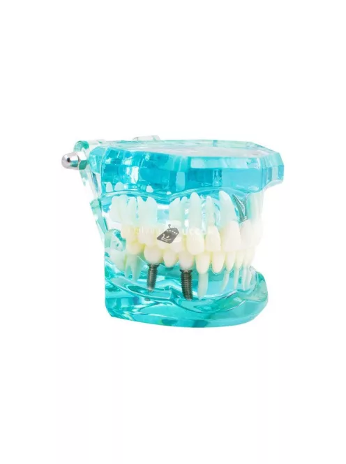 Fogmodell állkapocs fogak fog implantátumok - Fogorvosi modell állkapocs fogakkal és implantátumokkal
