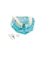 Fogmodell állkapocs fogak fog implantátumok - Fogorvosi modell állkapocs fogakkal és implantátumokkal