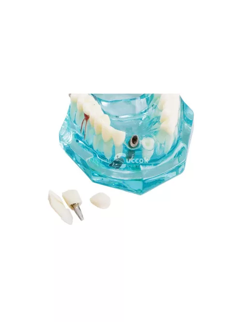 Fogmodell állkapocs fogak fog implantátumok - Fogorvosi modell állkapocs fogakkal és implantátumokkal