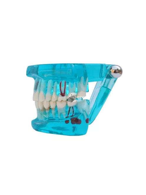 Fogmodell állkapocs fogak fog implantátumok - Fogorvosi modell állkapocs fogakkal és implantátumokkal