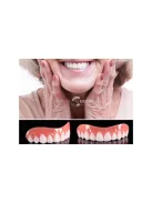 Fogvédő mű fogak mosoly tokban - fogvédő, műfog, mosoly, tok, fogpótlás, fogpótló, műfogak, szájvédő, fogvédés