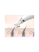 Mitesszer eltávolító eszköz