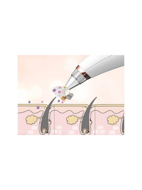 Mitesszer eltávolító eszköz